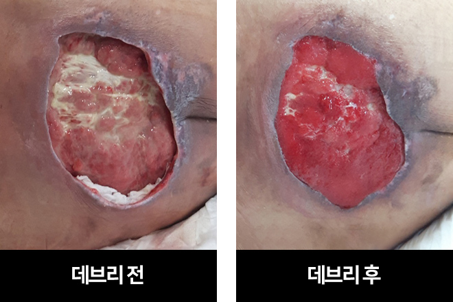 자애 욕창치료 자애 욕창치료